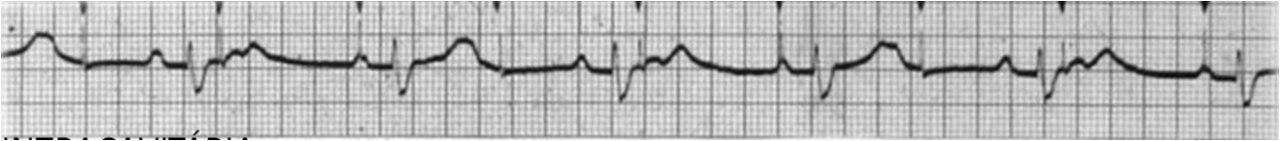 Marcapasos transitorio con electrodo desplazado a AD y posterior reposicionamiento