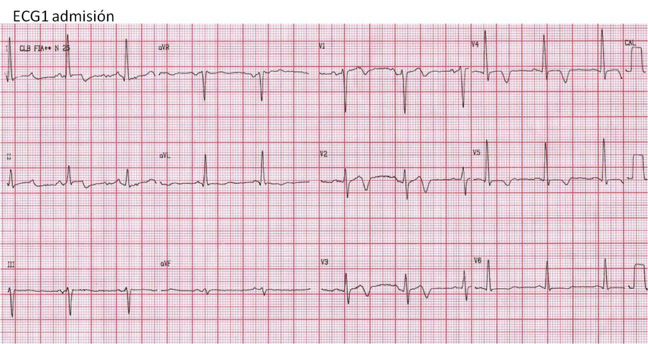 Masculino 56 años con mareos, vómitos, debilidad, nistagmus, ataxia de miembros inferiores. Lesiones coronarias mínimas