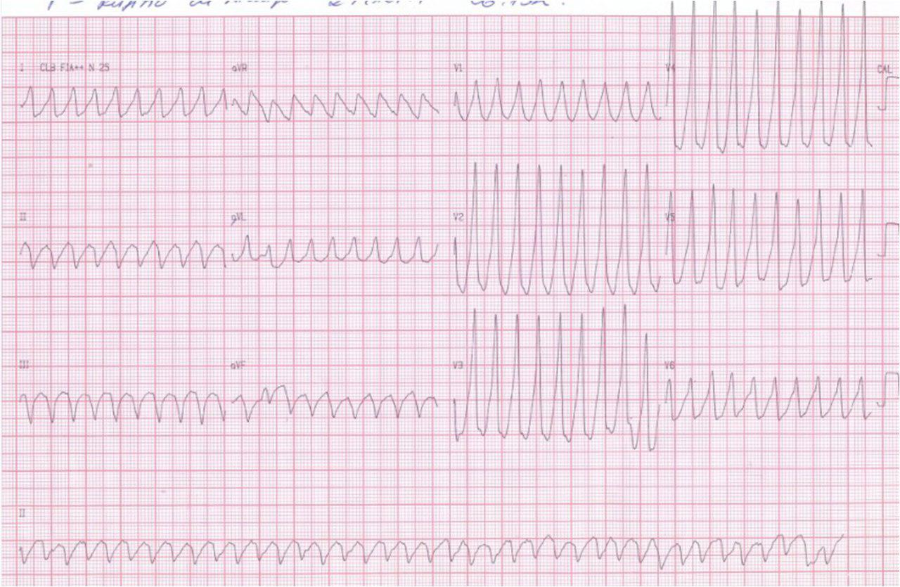 Masculino 62 años chagásico, con episodio sincopal. Coronarias normales y disquinesia apical