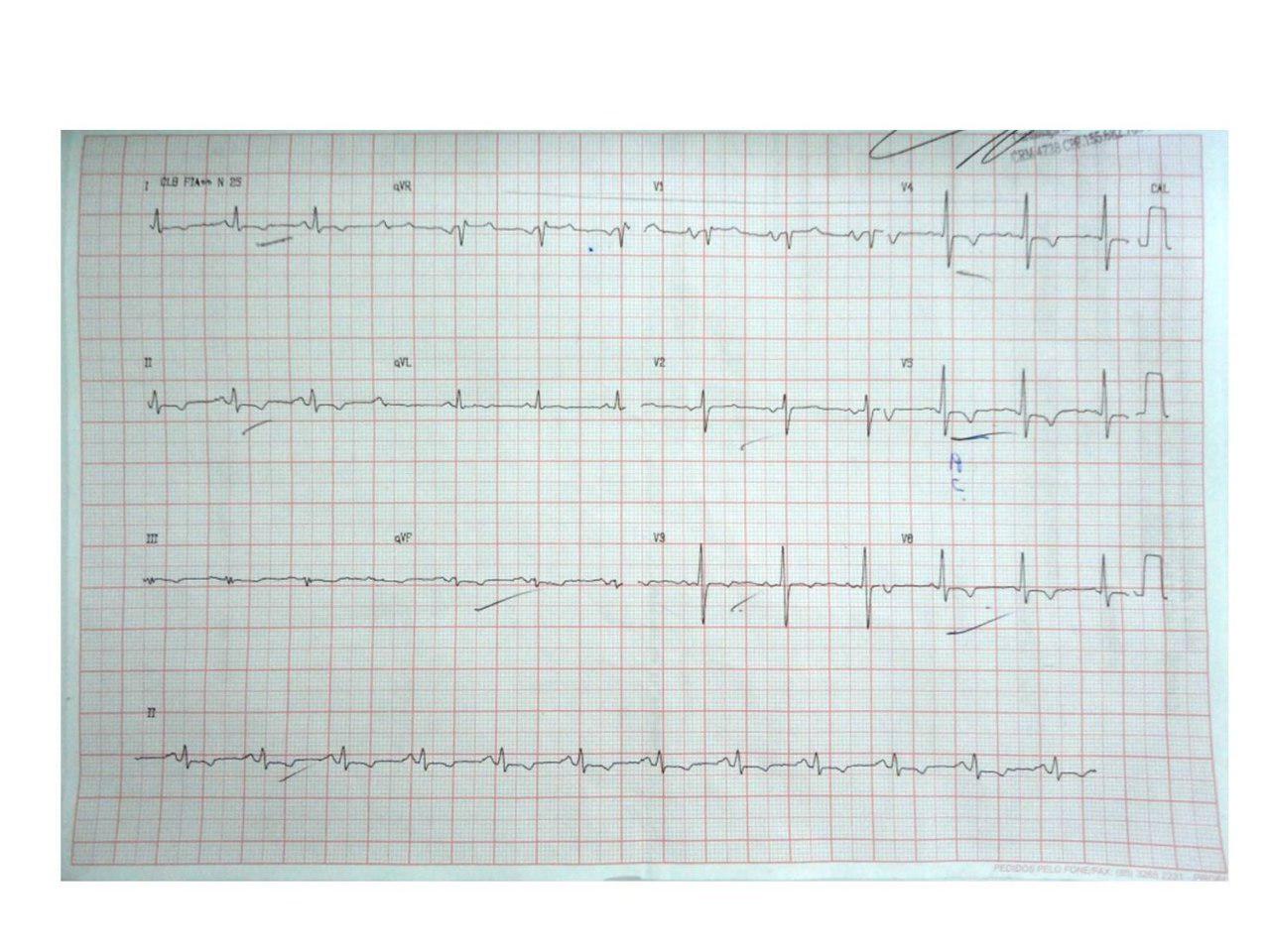 Masculino de 33 años con pericarditis constrictiva tuberculosa