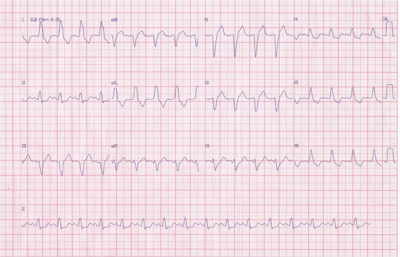 Mujer 53 años con angor prolongado y síncope con patrón de isquemia circunsferencial por enfermedad de 3 vasos.