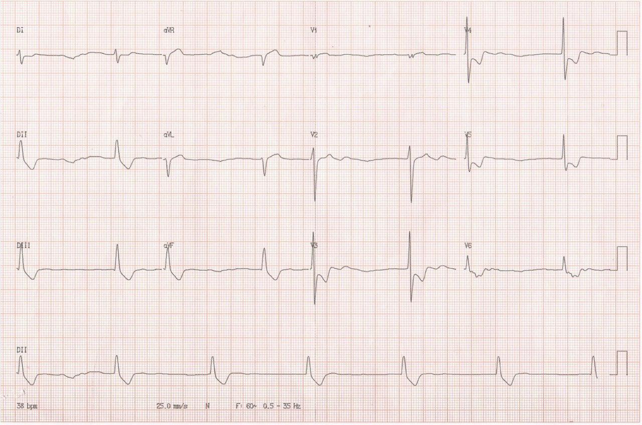 Mujer 70 años Confusión mental y visión borrosa con alucinaciones. Intoxicación digitálica