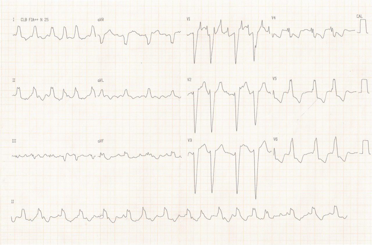 Mujer 28 años. Palpitaciones taquicárdicas y disnea. Síndrome de Turner mosaico