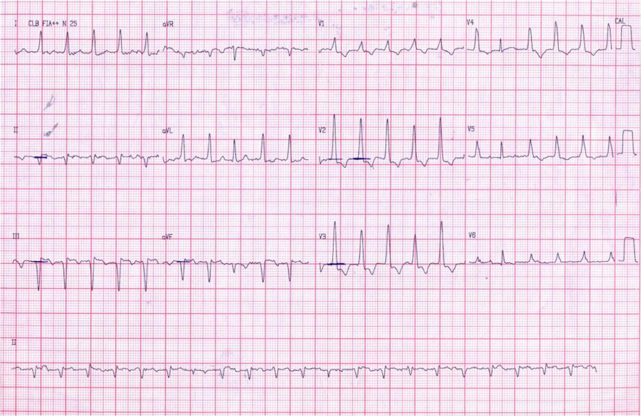 Mujer 46 años HTA y DBT. Taquicardia fascicular posterior. IAMCEST inferior 12 días previos