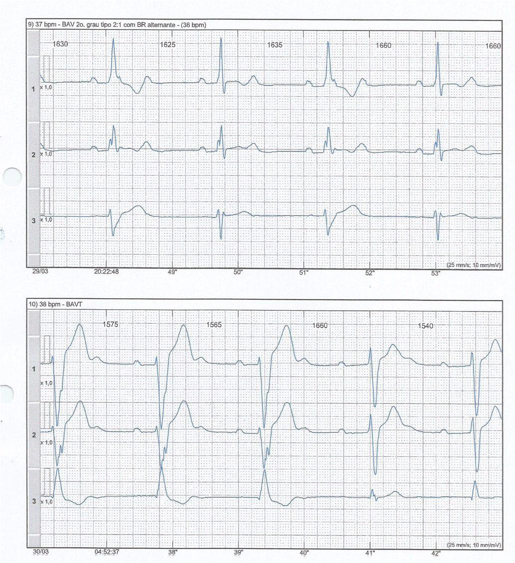 Mujer 47 años con Distrofia Miotónica  con 3 episodios de síncope