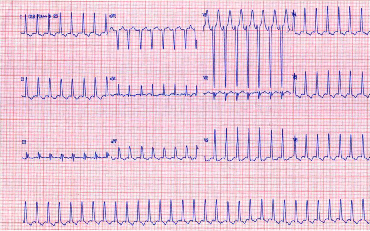 23 años, palpitaciones, disnea de esfuerzo por taquicardia auricular que responde a adenosina