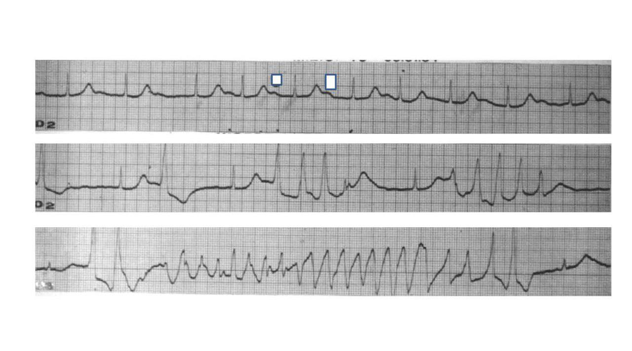 Male patient medicated with quinidine and propranolol consultation for syncope