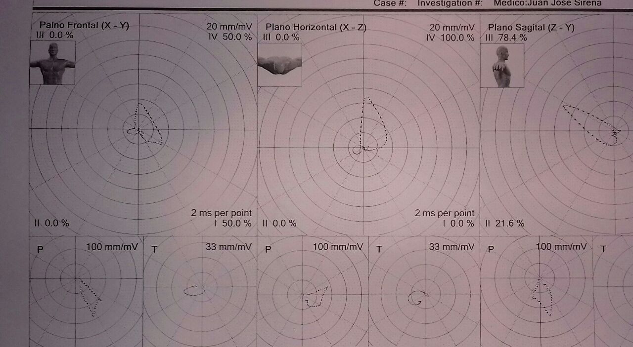 Masculino de 60 años portador de cardiopatía isquémica. Interpretación VCG