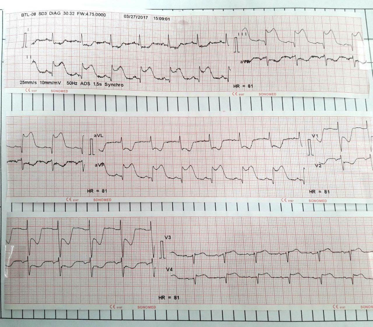 Infarto hiperagudo de cara inferior