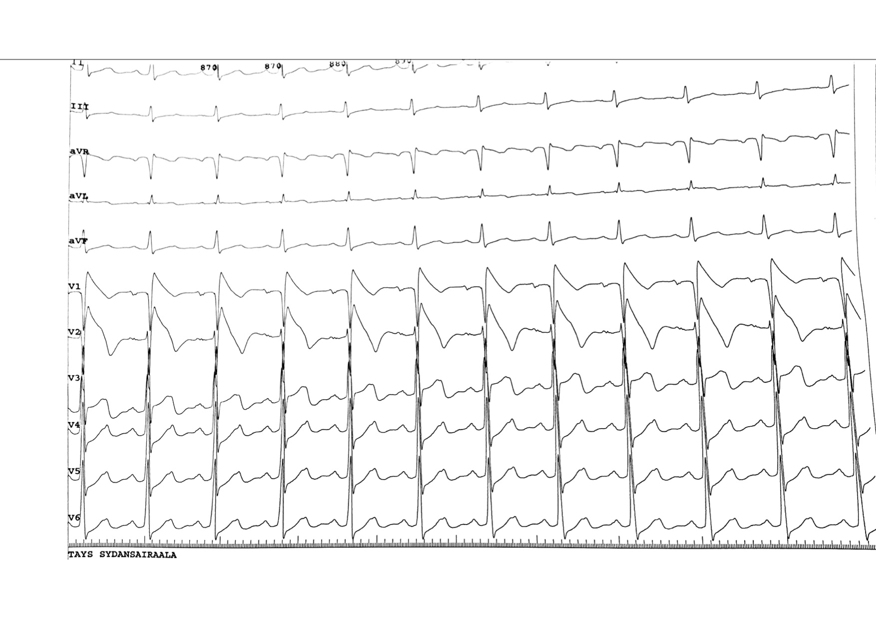 Positive ajmaline test, unmasks a typical Type I Brugada pattern.