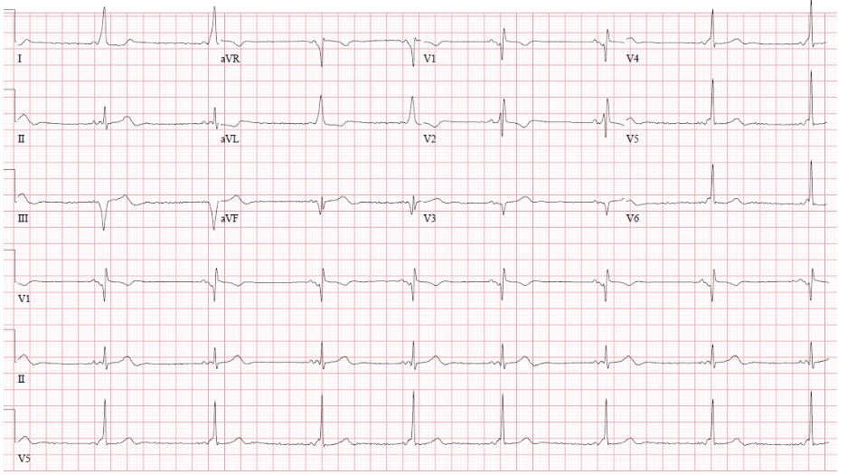 Ejemplos de vías anómalas de localización medio septal