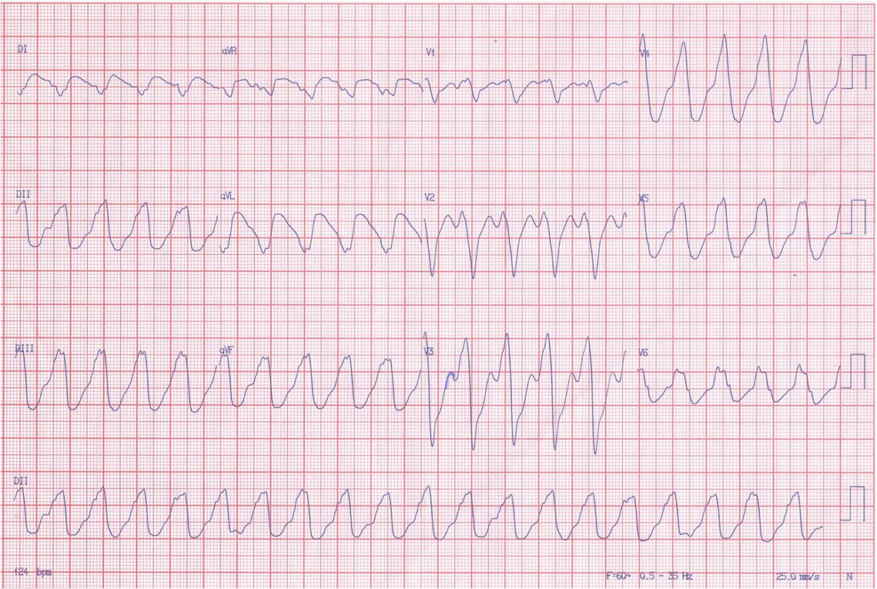Masculino 30 años. Miocardiapatia dilatada no isquémica ni Chagásica. CDI p/muerte súbita recuperada