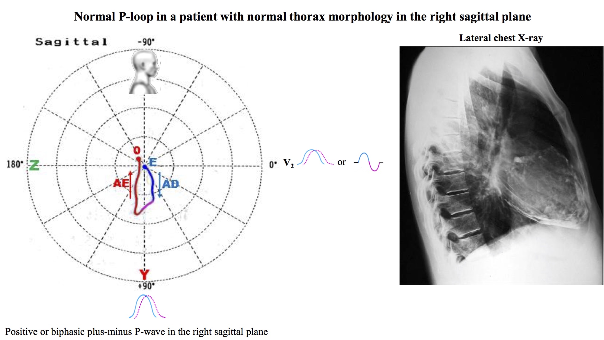 Normal and pectus excavatum P-loop in the right sagittal plane