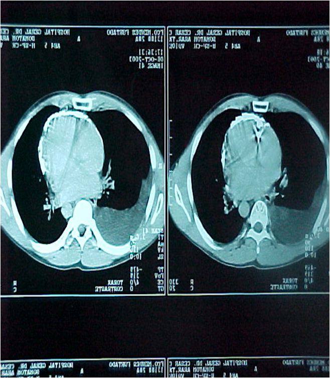 Pericarditis constrictiva en una TAC