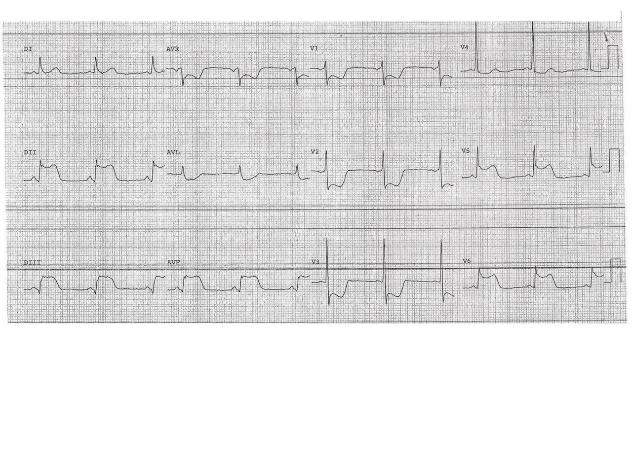 Mujer 66 años con FR. Ingresa por angor prolongado.
