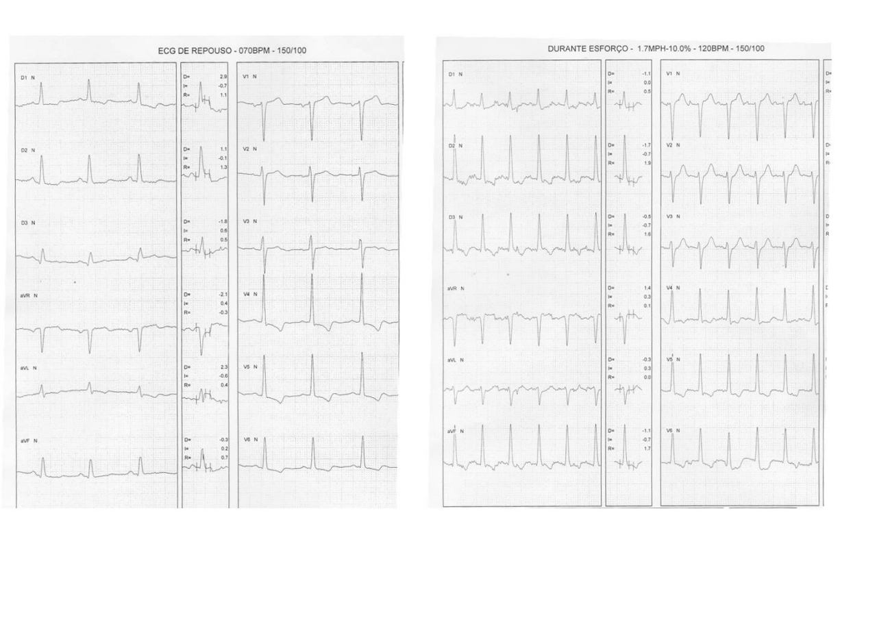 Fememina de 68 años, asintomática. Francos antecedentes coronarios. PEG de control