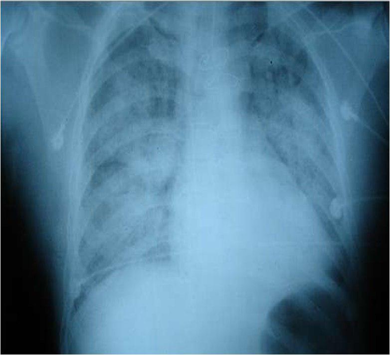 Edema Agudo de Pulmón por ruptura de músculo papilar durante IAM