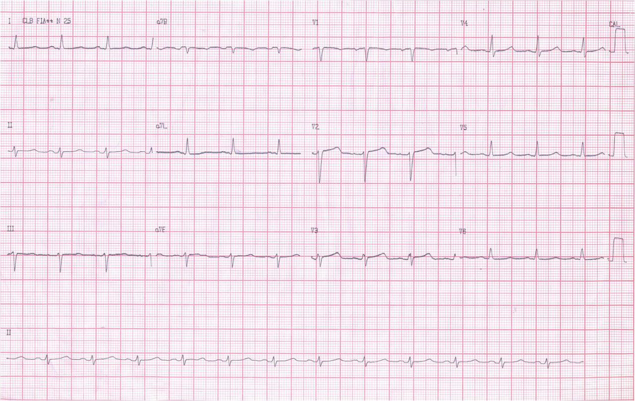 Masculino 42 años. FV abortada con HVI concéntrica. CDI y muerte posterior. Amiloidosis cardíaca