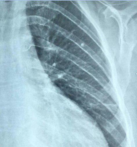 Lesiones osteolíticas por circulación colateral en coartación aórtica