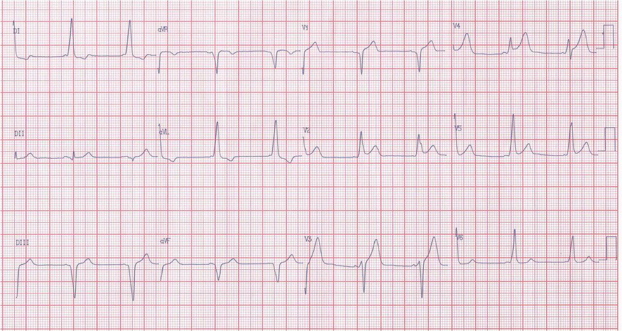 Masculino de 52 años portador de WPW que presenta SCA