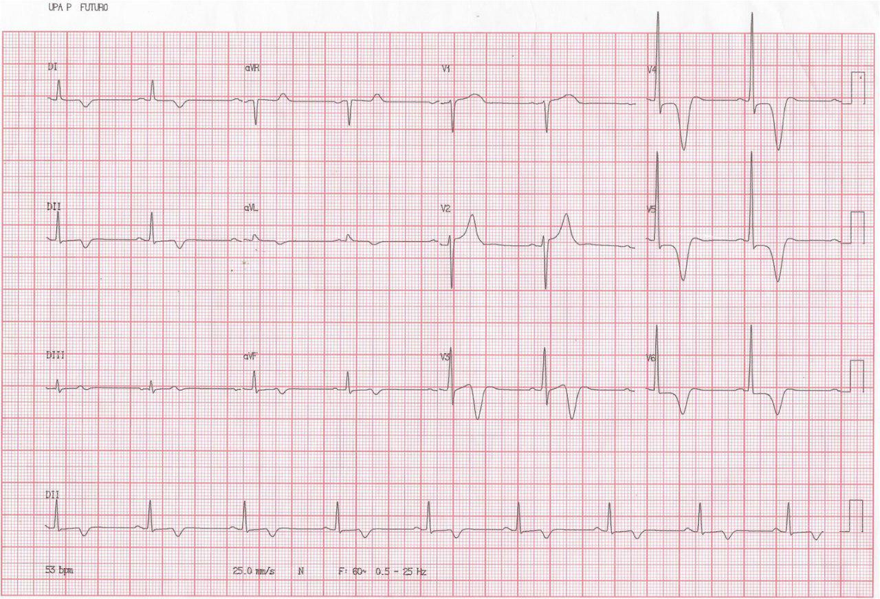 Masculino 31 años, Disnea de esfuerzo, mareos y palpitaciones. Miocardiopatía hipertrófica apical