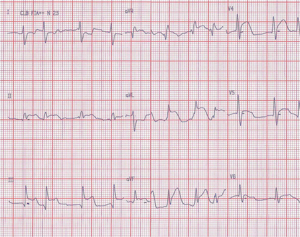 Masculino 64 años IAM de VD por embolia coronaria