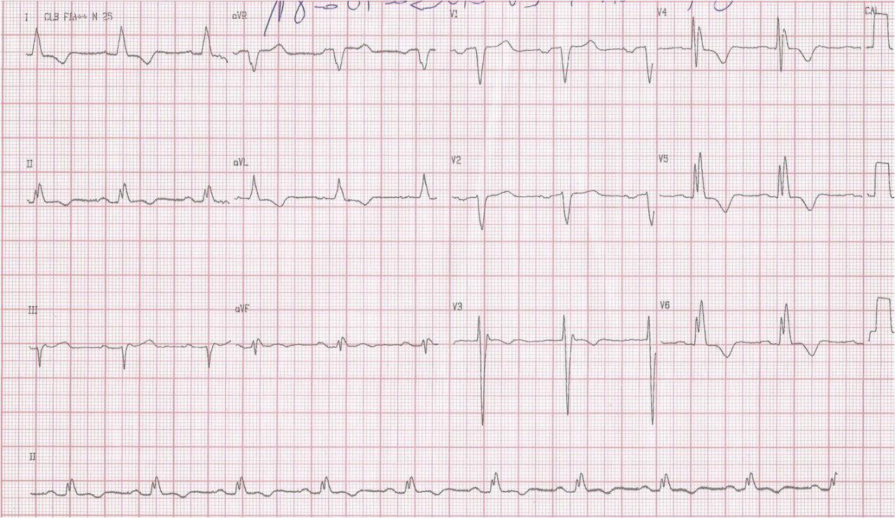 Masculino de 53 años. Palpitaciones y sincope. Atc de TV. MCH  Medio Ventricular