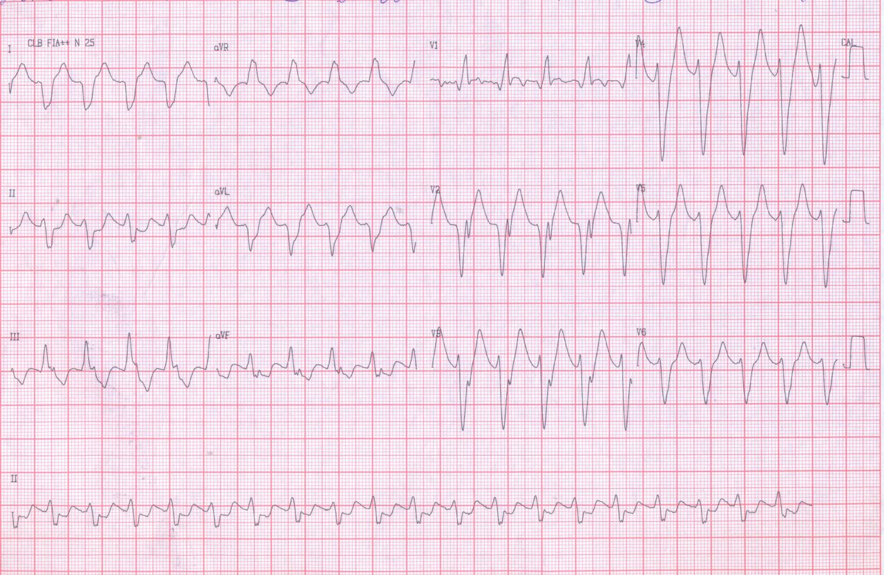 Masculino de 62 años con IAM previo. Stent y  revascularización miocárdica quirúrgica