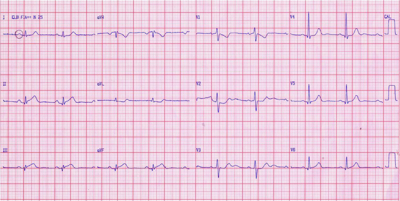 Hombre de 57 años, HTA y DBT, con SCACEST