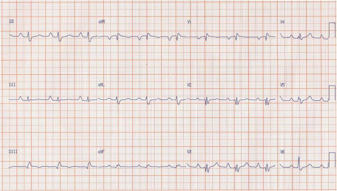 Hombre de 43 años: Enfermedad de Ebstein.