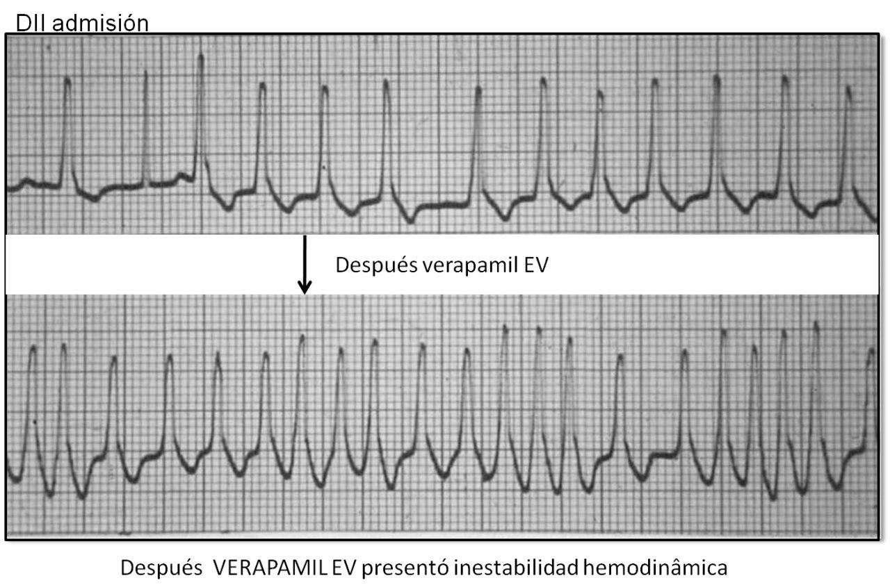 FA en paciente de 23 años portador de WPW con errónea indicación de verapamil EV