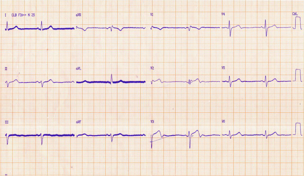 Masculino de 59 años. con IAM por oclusión de DA y S de Brugada concomitante