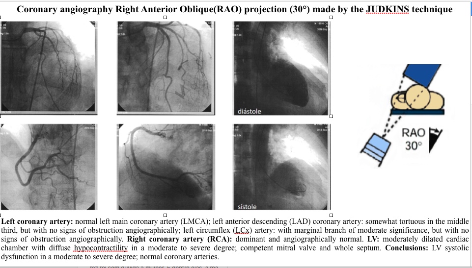 LV systolic dysfunction in a moderate to severe degree; normal coronary arteries.