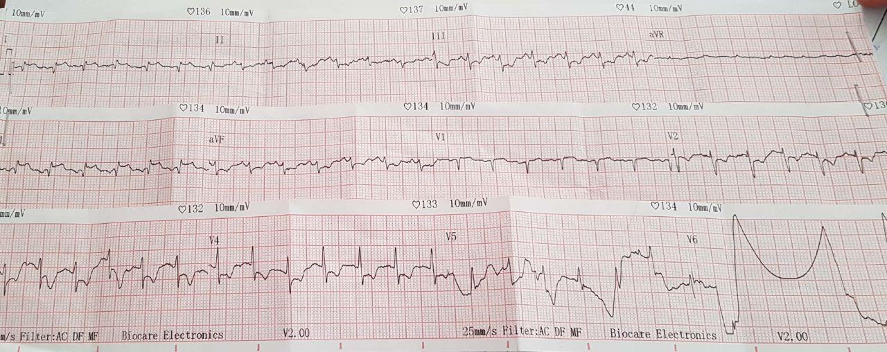 Mujer de 33 años con hemorragia vaginal de 3g/dl que luego se corrige a 8g/dl