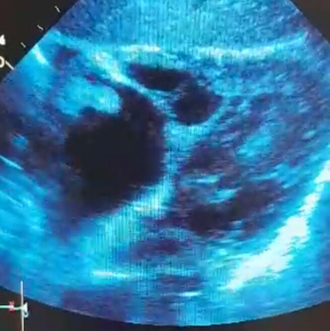 Imagen compatible con mixoma pediculado en Aurícula derecha en paciente portador de severa silicosis con hipertensión pulmonar