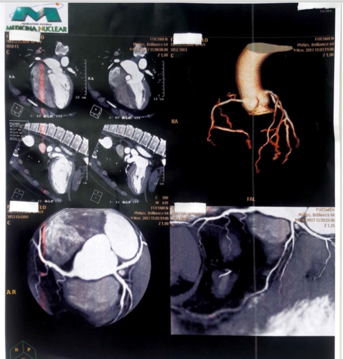 Angioresonancia:  ausencia de tronco de CI; la Cx y la DA nacen del seno coronariano izquierdo, en «caño de escopeta»