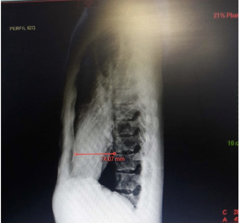 Varón de 21 años con espalda recta y pectum excavatum leve