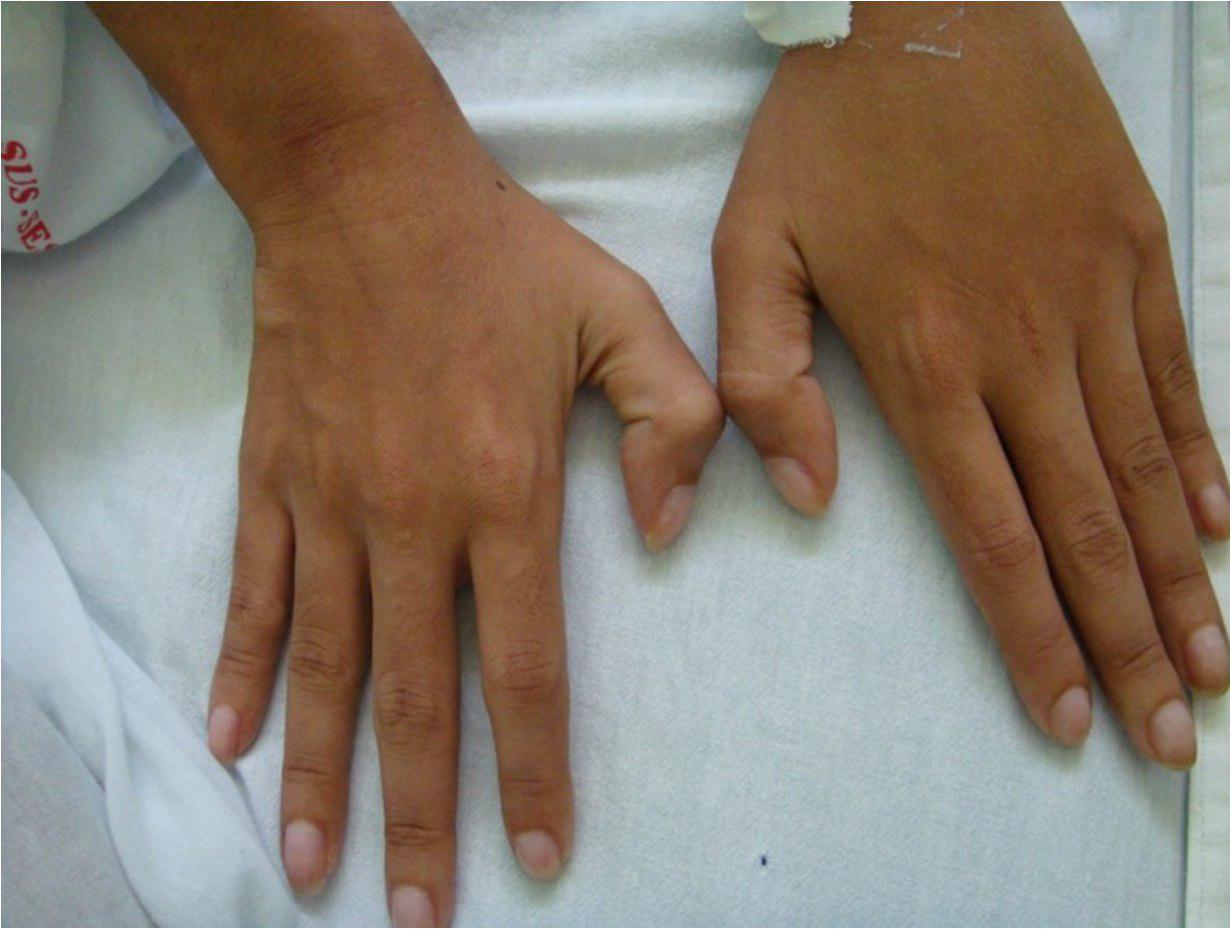 Hipocratismo digital por endocarditis bacteriana