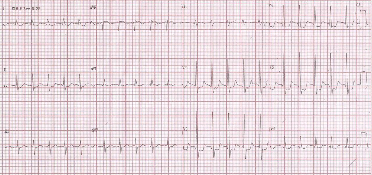 Paciente de 74 años con angor prolongado. Taquicardia de QRS angosto que revierte con adenosina y severa enfermedad coronaria