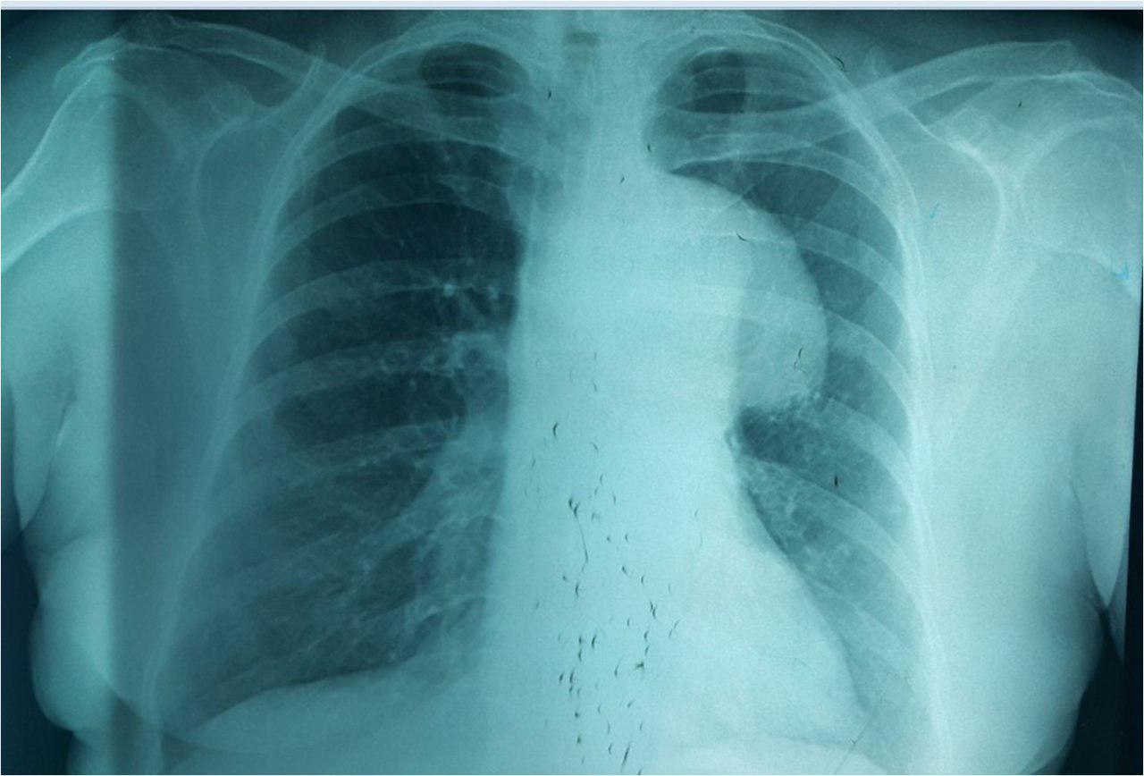 Mujer de 68 años hipertensa, con ronquera por aneurisma de aorta con compresión de nervio recurrente