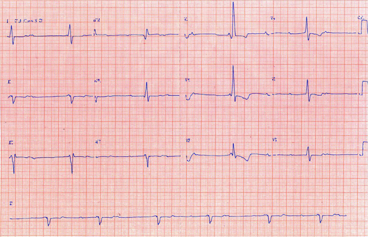 Endocarditis infecciosa con  trastornos de conducción por absceso del anillo valvular