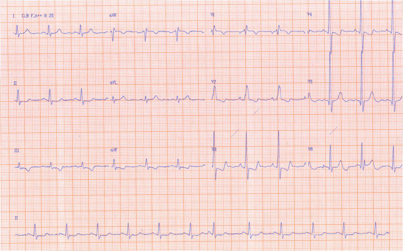 Paciente con síndrome ascítico edematoso originado en mixoma pediculado de aurícula izquierda