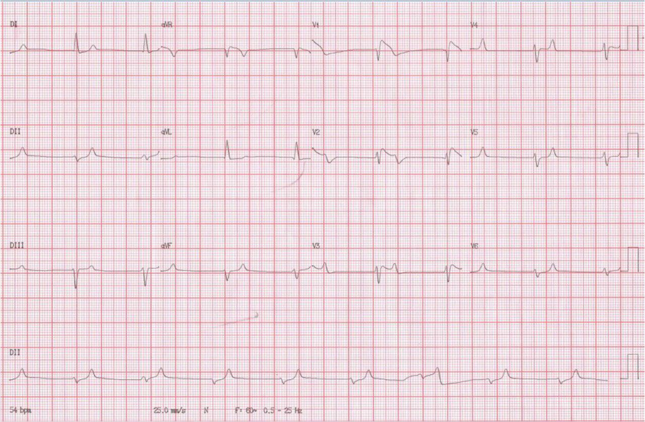 Fenocopia de Brugada por hiperpotasemia de 6.7 mEq/l en paciente séptico