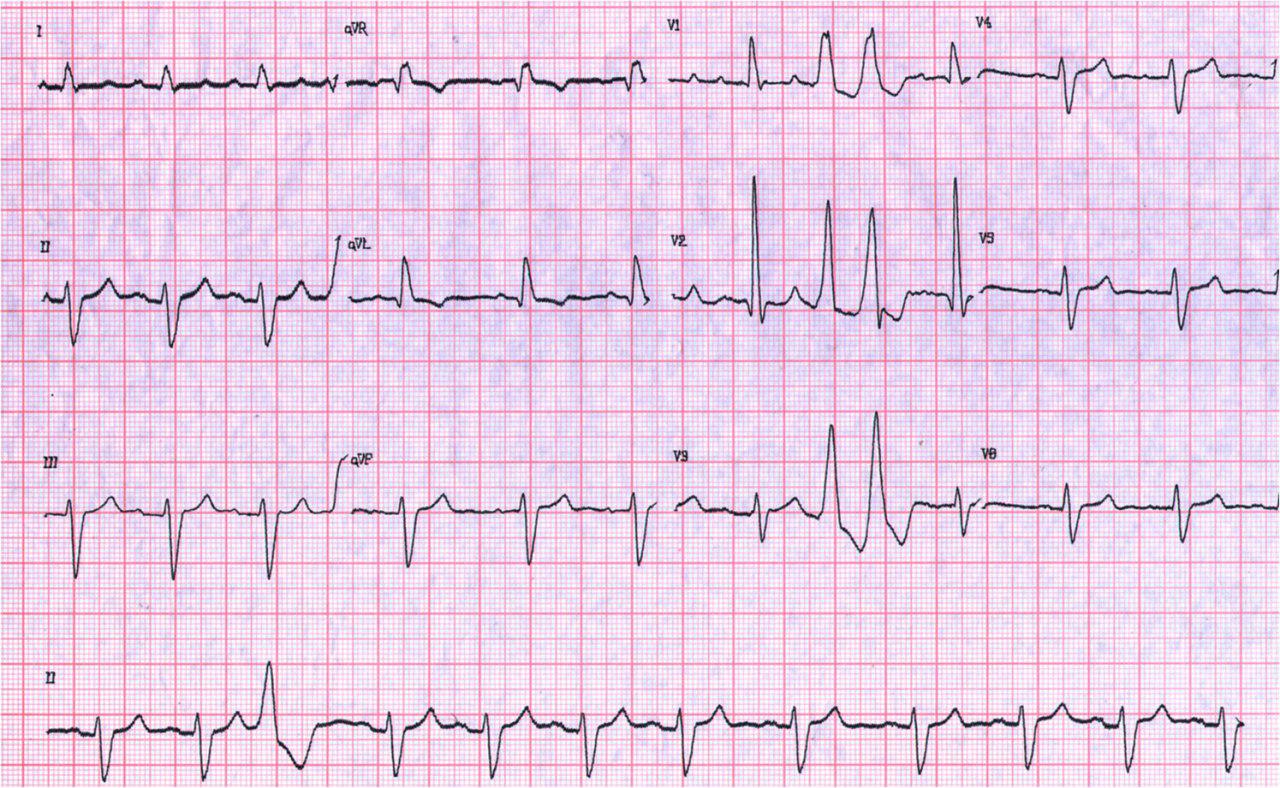 Femenina de 78 años, chagásica, con episodios sincopales. Aneurisma ventricular