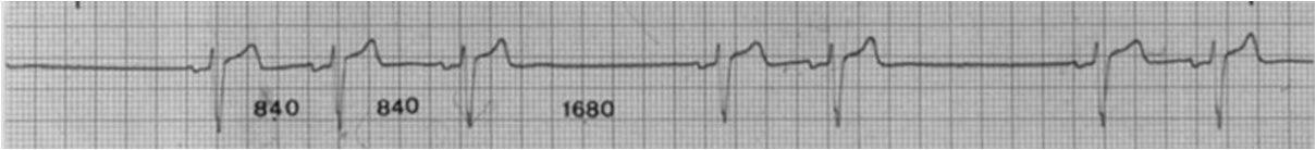 Episodio sincopal por bloqueo sino-atrial