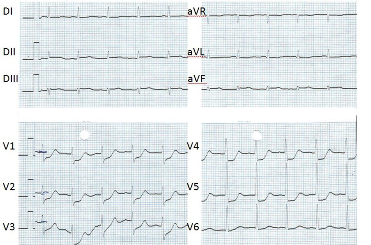 IAM por compromiso de arteria circunfleja