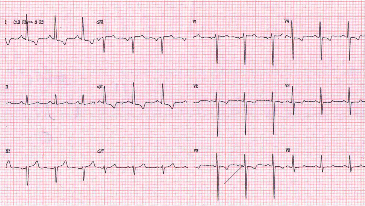 Paciente de 54 años con angor prolongado, dextrocardia y suboclusión de TCI