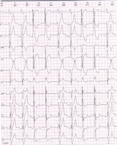 Síndrome de Rosenbaum