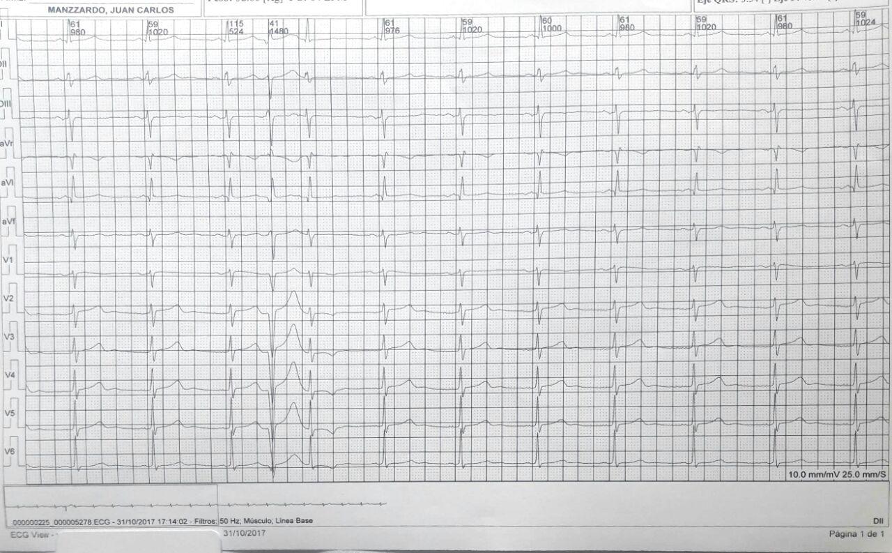 Mujer portadora de MP modo AAI. Registro con y sin filtro muscular (pasa bajo)  que permite observar espigas