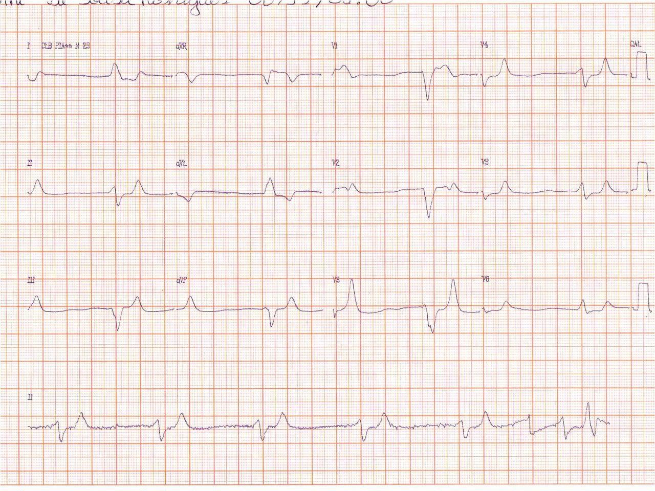 Femenina de 86 años, DBT e HTA con grave hiperpotasemia que requiere gluconato de Ca en la emergencia